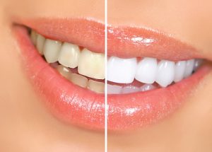 Ouch! How Can I Whiten My Sensitive Teeth?