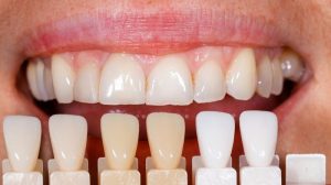 Crowns or Veneers? Let’s Compare