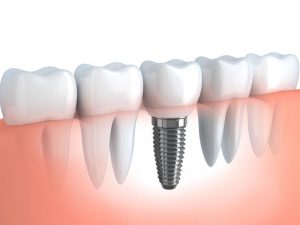 Dental Implants in Las Vegas, NV